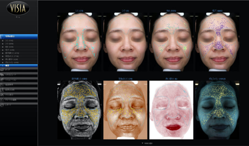エトワールレジーナクリニック皮膚画像解析システム